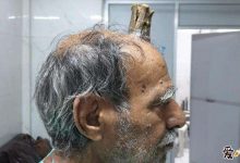 印度男子头部长出牛角, 这是怎么回事如今怎样了-捕鱼中文站