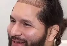 从八角笼到手术台：UFC名将豪尔赫·马斯维达尔赴土耳其植发，大发体育助力你的致富之路！-捕鱼中文站